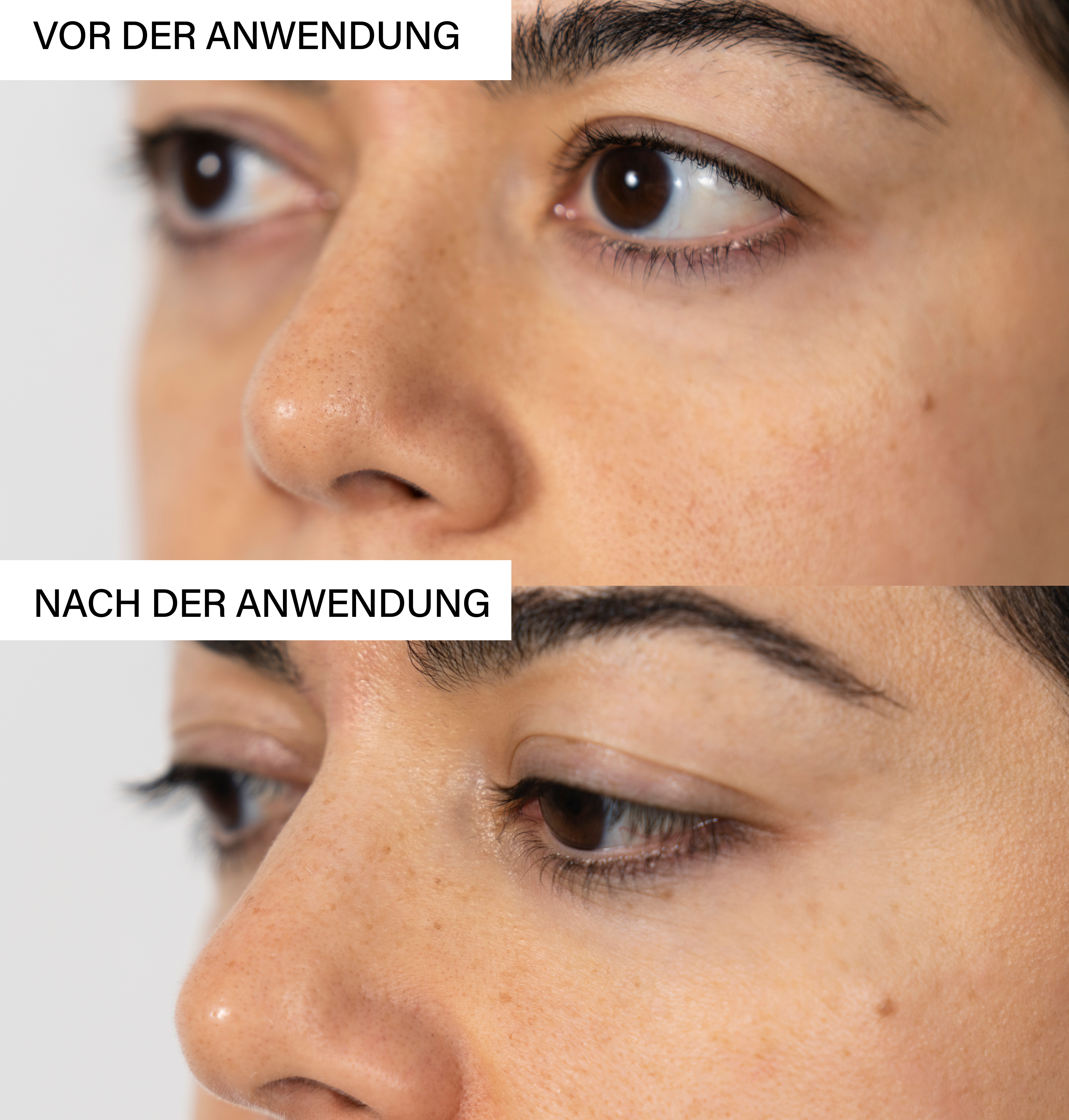 Skin Exfoliating Peeling | Pore refining treatment