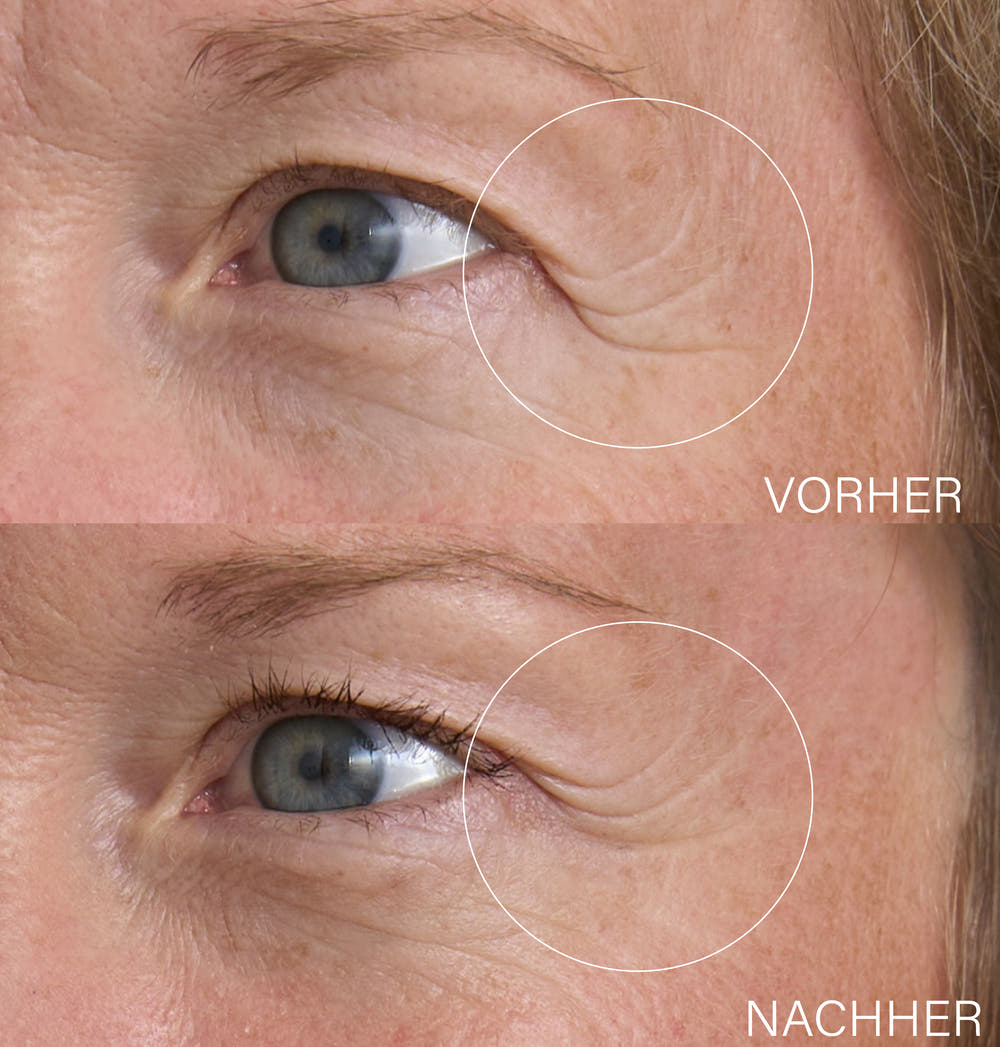 Hyaluron Lifting Duo