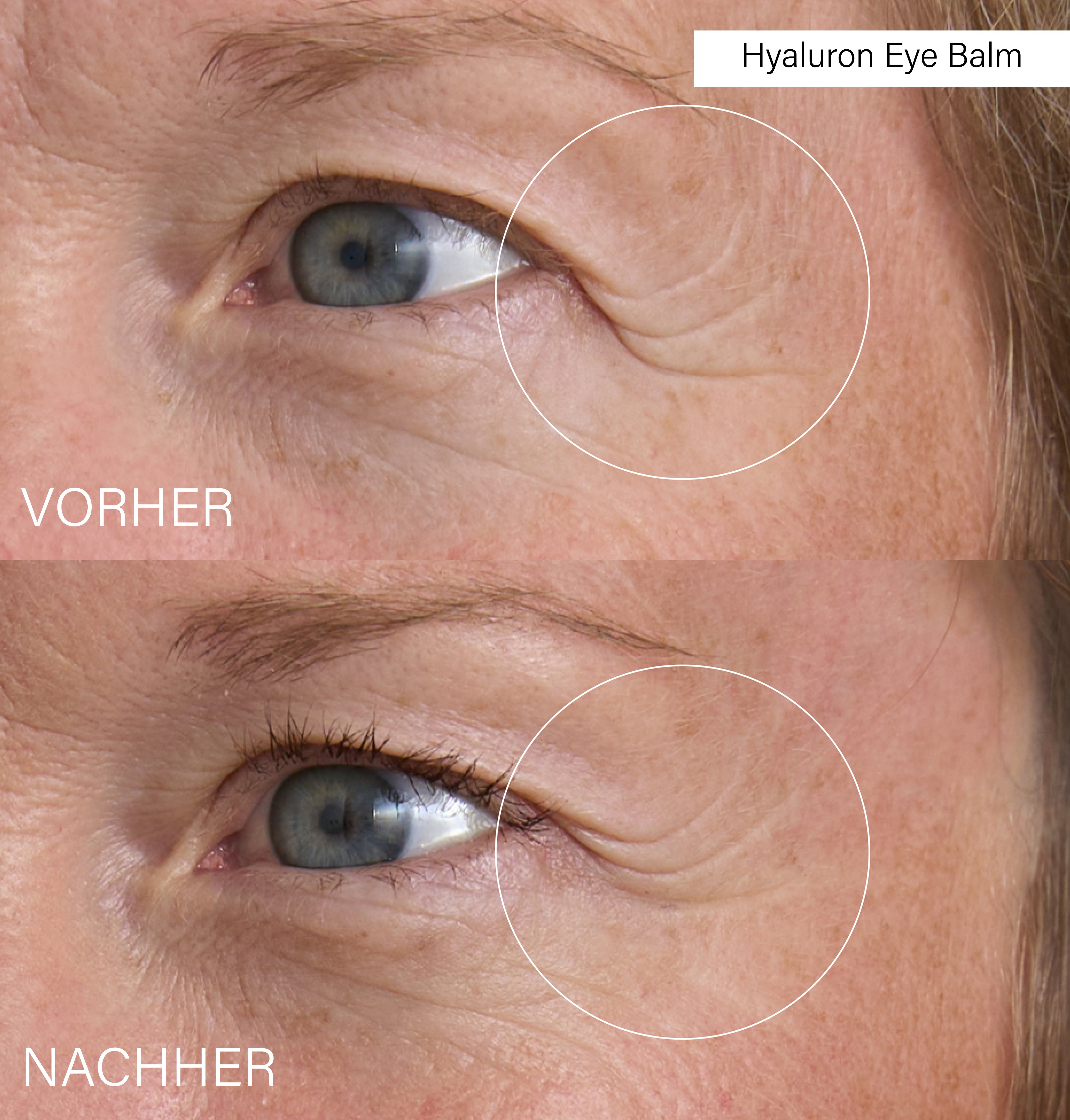 Full Lifting Eye Set